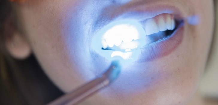 You Shouldnt Get Your Teeth Whitened if You Fall into These 9 Categories